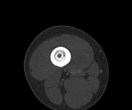 Osteoid osteoma - femoral | Radiology Case | Radiopaedia.org