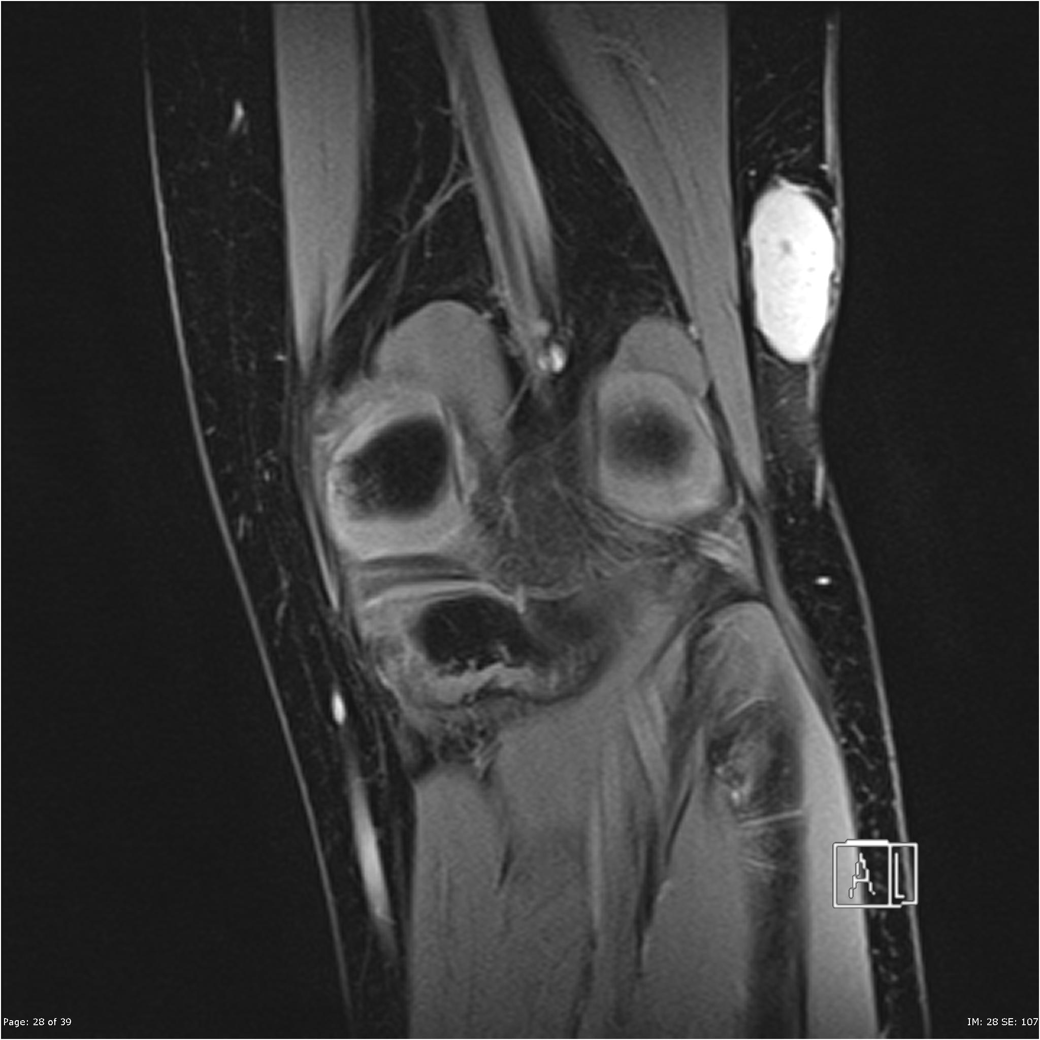 Synovial sarcoma | Image | Radiopaedia.org