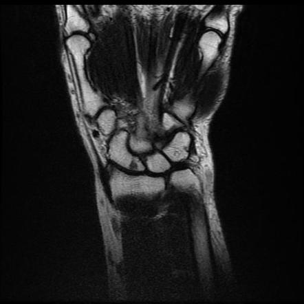 Isolated pisiform bone fracture - chronic (MRI) | Image | Radiopaedia.org