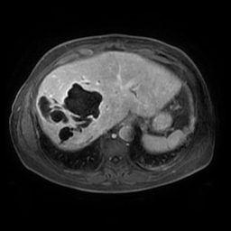 Hepatic hydatid disease - extension into the biliary tree and portal ...