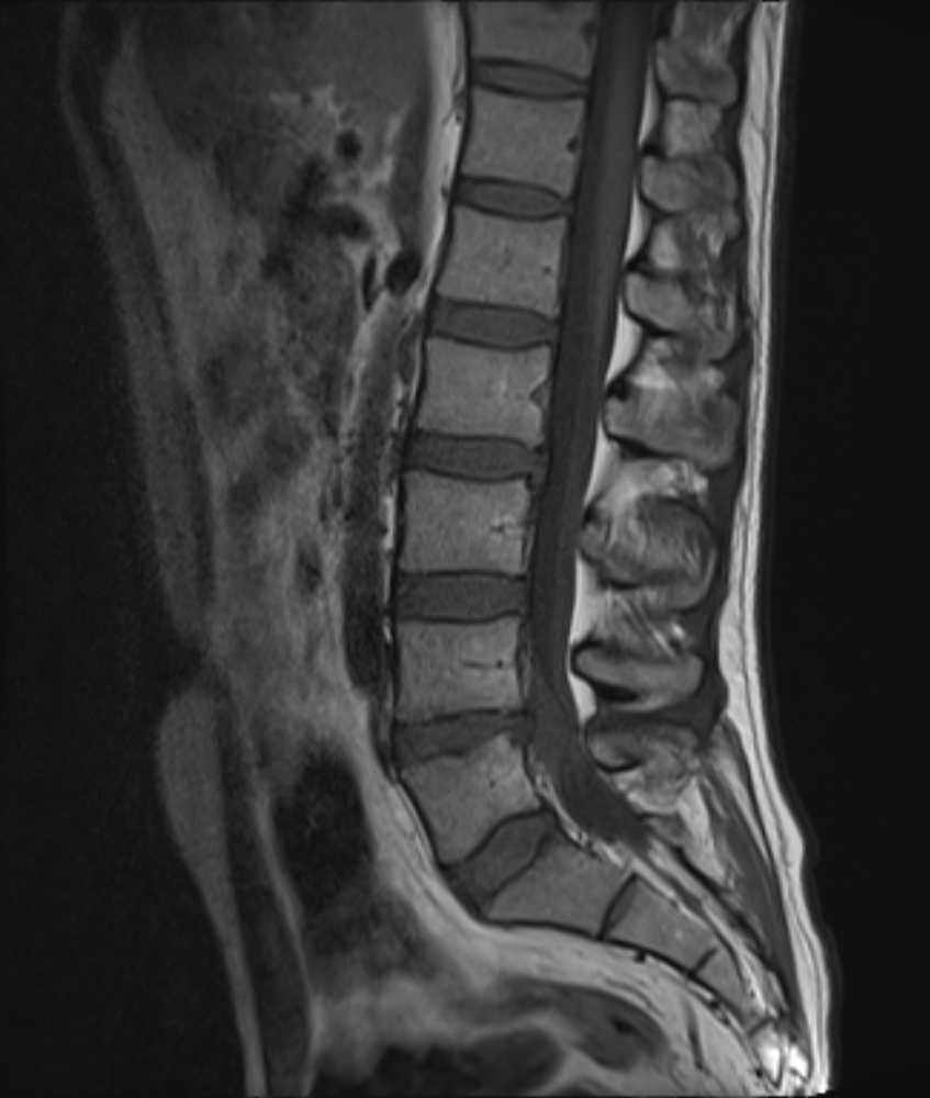 Disc extrusion | Image | Radiopaedia.org