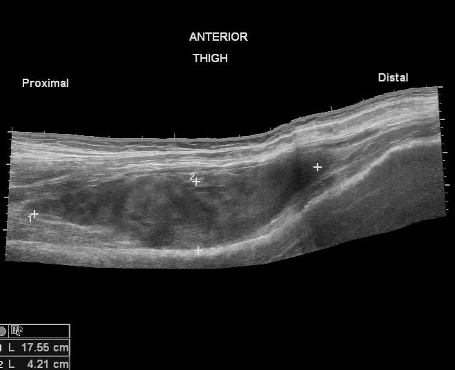 Giant Rectus Sheath Hematoma The Ultrasound Journal