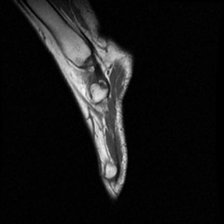 Accessory Navicular Radiology Reference Article Radiopaedia Org