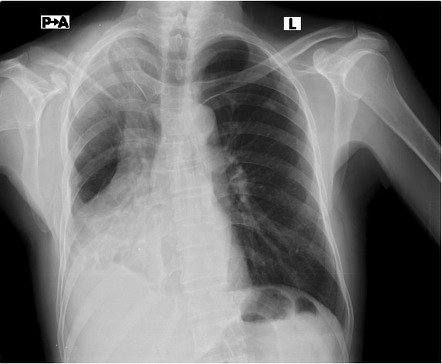 Chest x-ray after trauma | Radiology Case | Radiopaedia.org