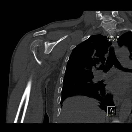 Humeral fracture with posterior shoulder dislocation | Radiology Case ...