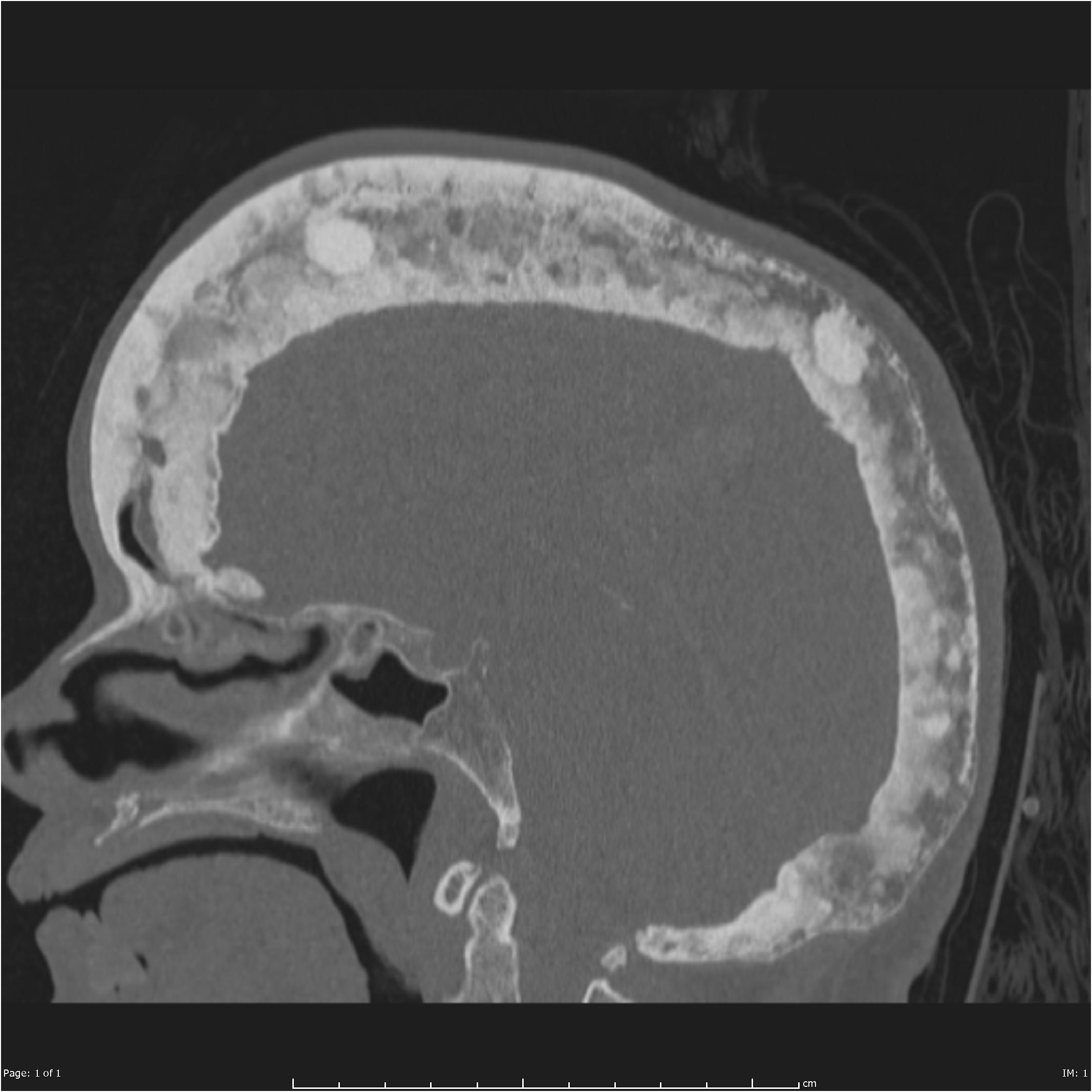 Paget disease of the skull Image