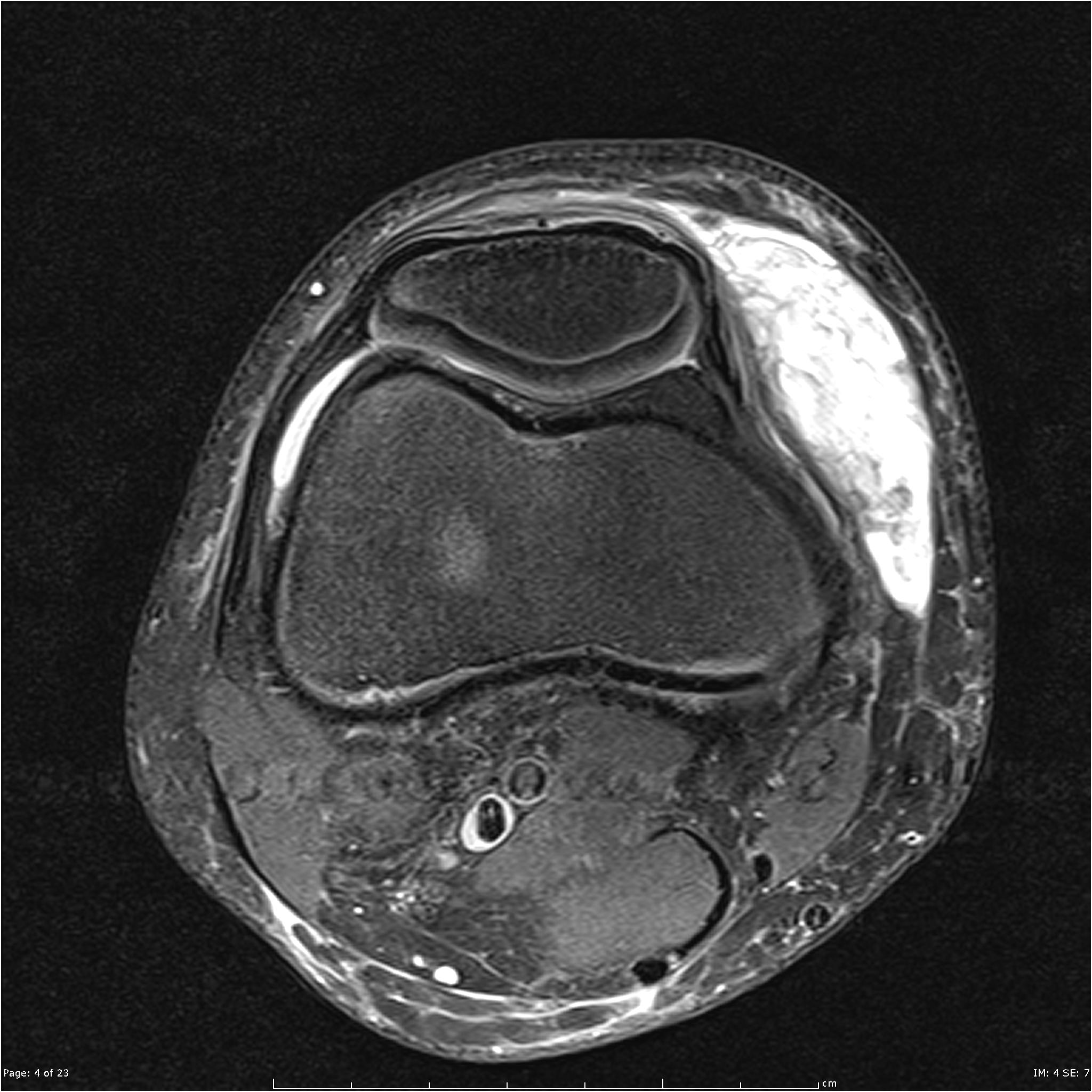 Soft tissue hematoma - knee | Image | Radiopaedia.org