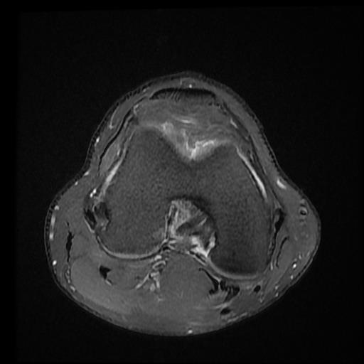 Bucket-handle meniscal tear | Image | Radiopaedia.org