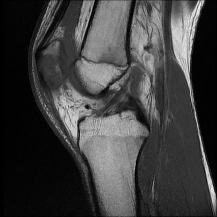 Patellar fracture - non-displaced (MRI) | Image | Radiopaedia.org