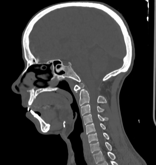 Os odontoideum with cleft of the posterior arch of C1 | Image ...