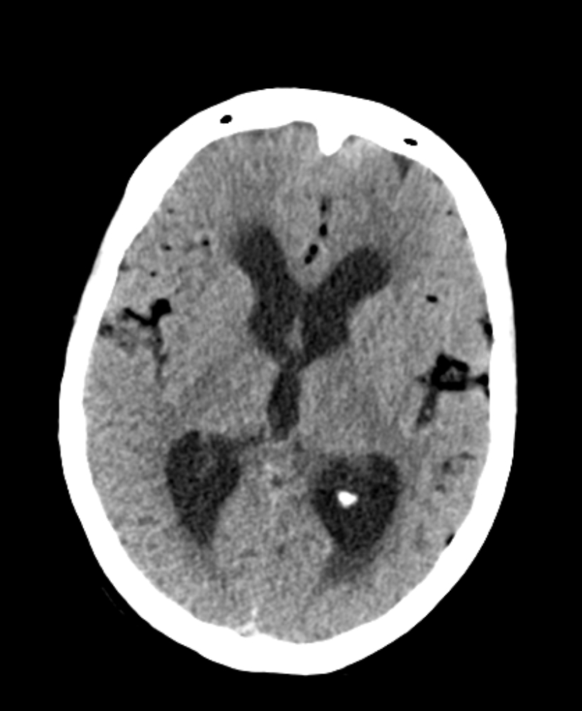 Ruptured Intracranial Dermoid Cyst Cerebellopontine Angle Image