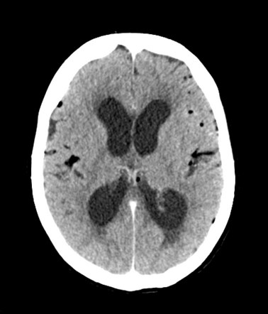 Ruptured intracranial dermoid cyst - cerebellopontine angle | Image ...