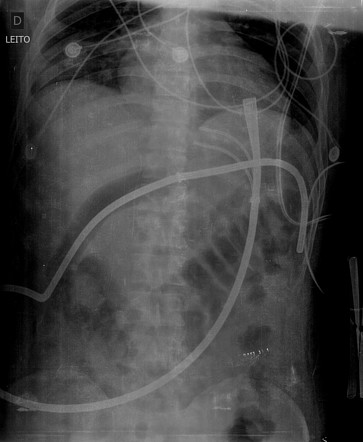 Transhepatic Sengstaken-Blakemore tube | Radiology Case | Radiopaedia.org