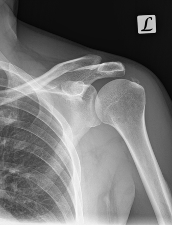 Calcific supraspinatus tendinitis | Image | Radiopaedia.org