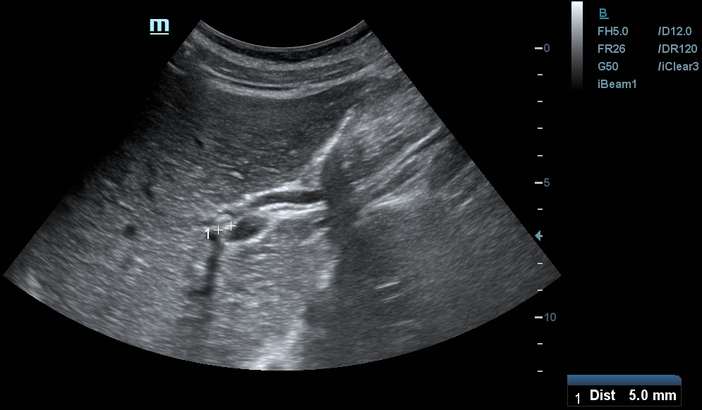 Intrahepatic bile duct stone Image