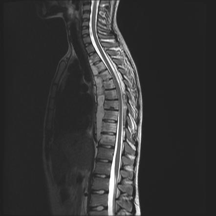 Spinal Epidural Abscess Radiology Case Radiopaedia Or - vrogue.co