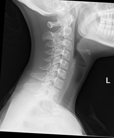 Normal soft tissue neck lateral radiograph | Radiology Case