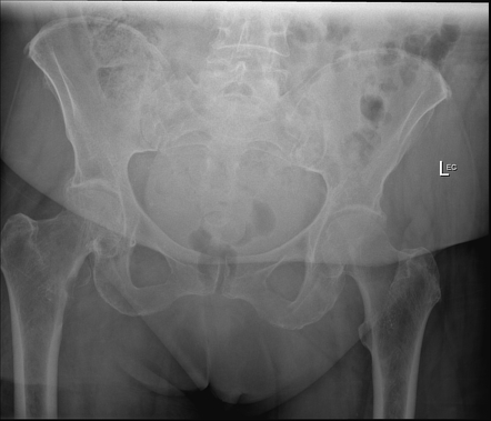 Lesser Trochanter Pathological Fracture Radiology Case Radiopaedia Org