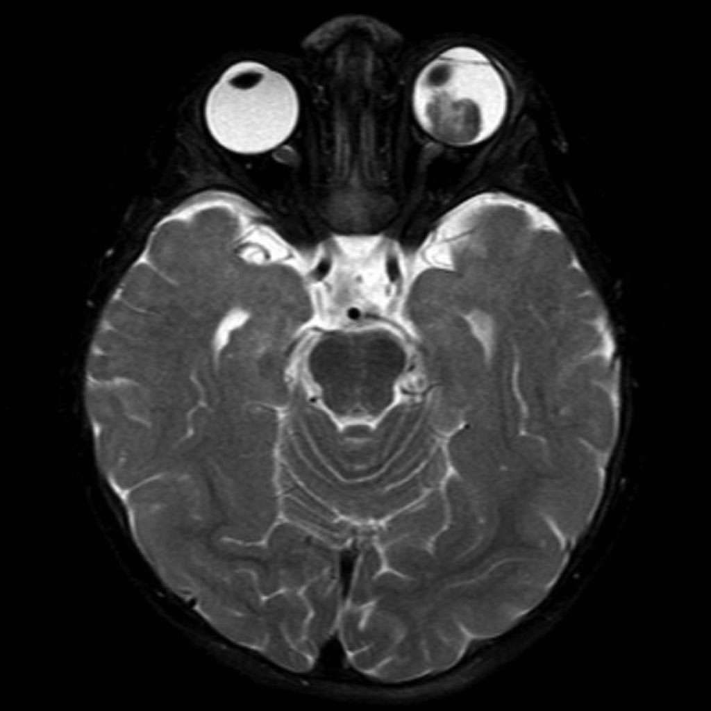 Глазных орбит и зрительных нервов. Retinoblastoma кт. Ретинобластома двусторонняя мрт.