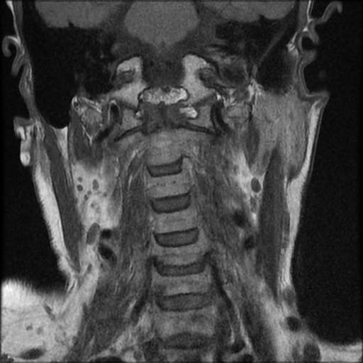 Atlantoaxial Subluxation Rheumatoid Arthritis Image