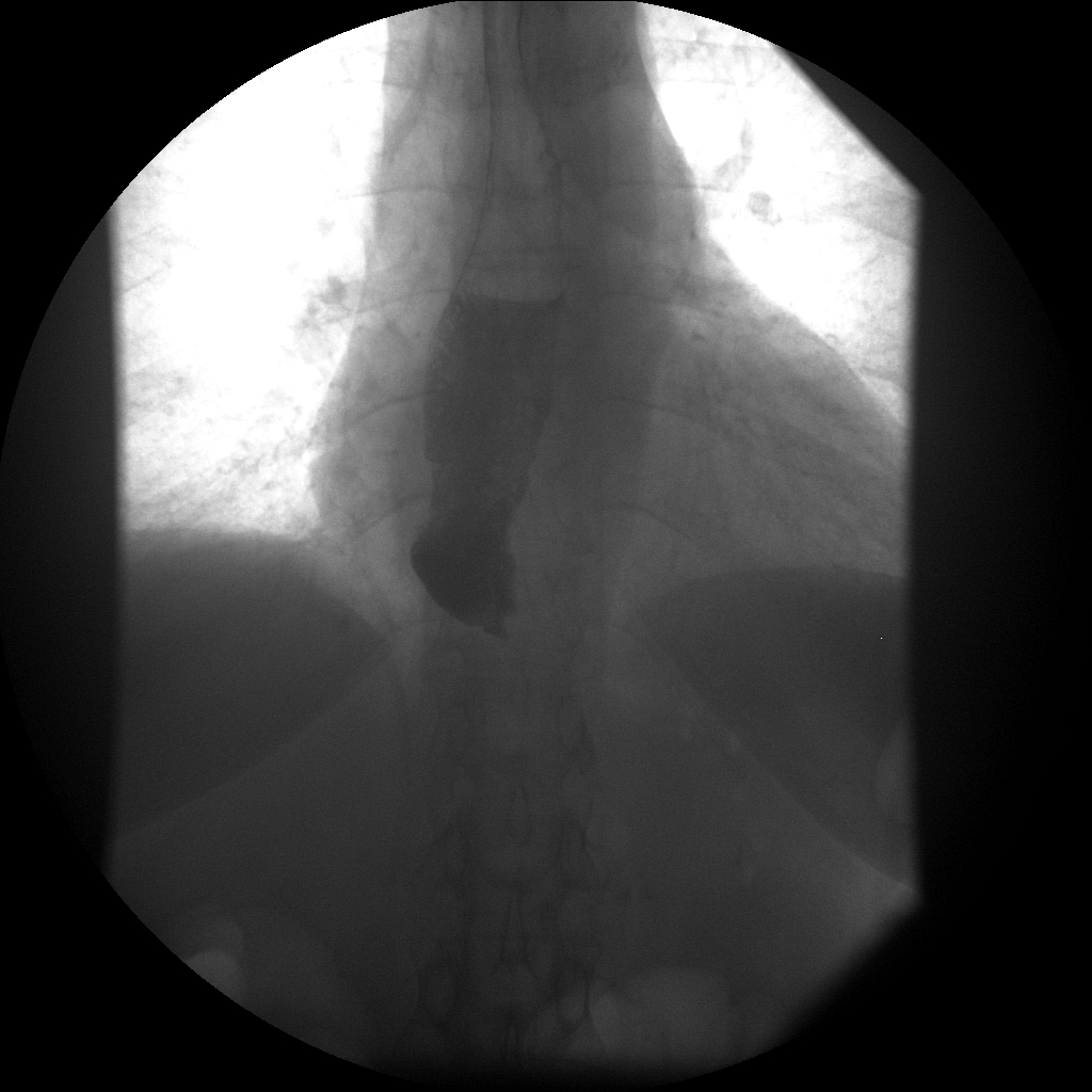 Esophageal Dysmotility - Systemic Sclerosis | Image | Radiopaedia.org