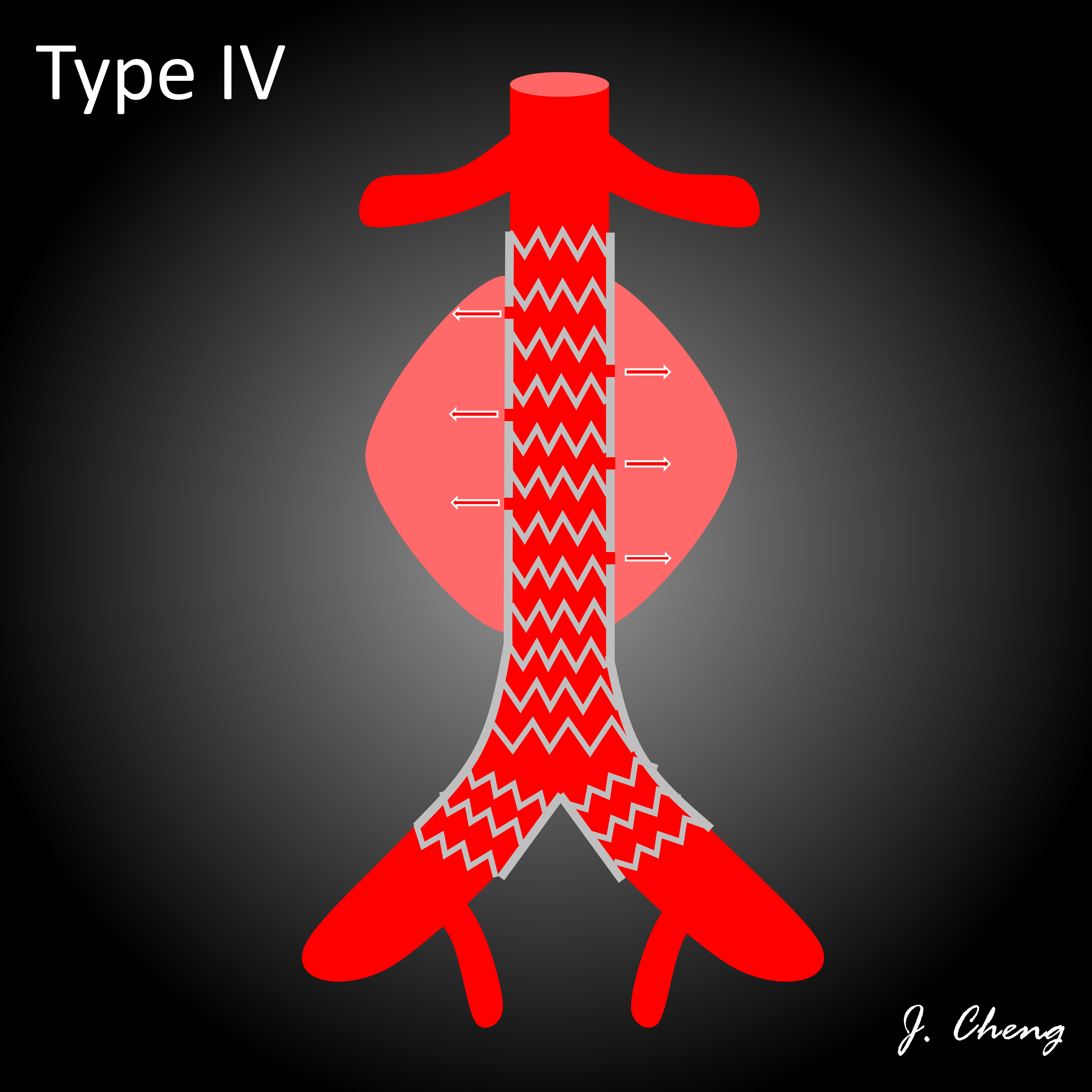 Endoleak Classification Diagram Image