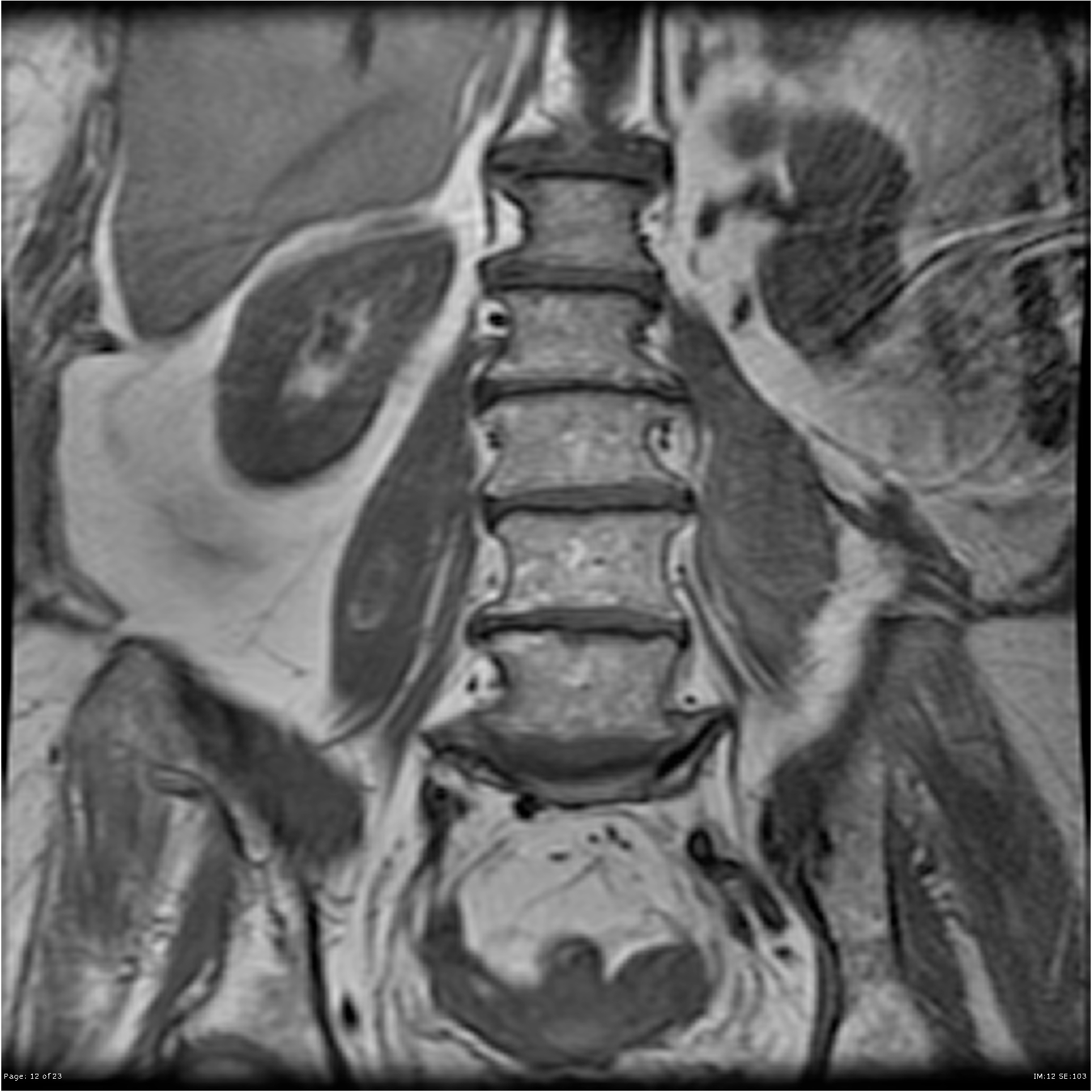 Bilateral psoas hematomas | Image | Radiopaedia.org