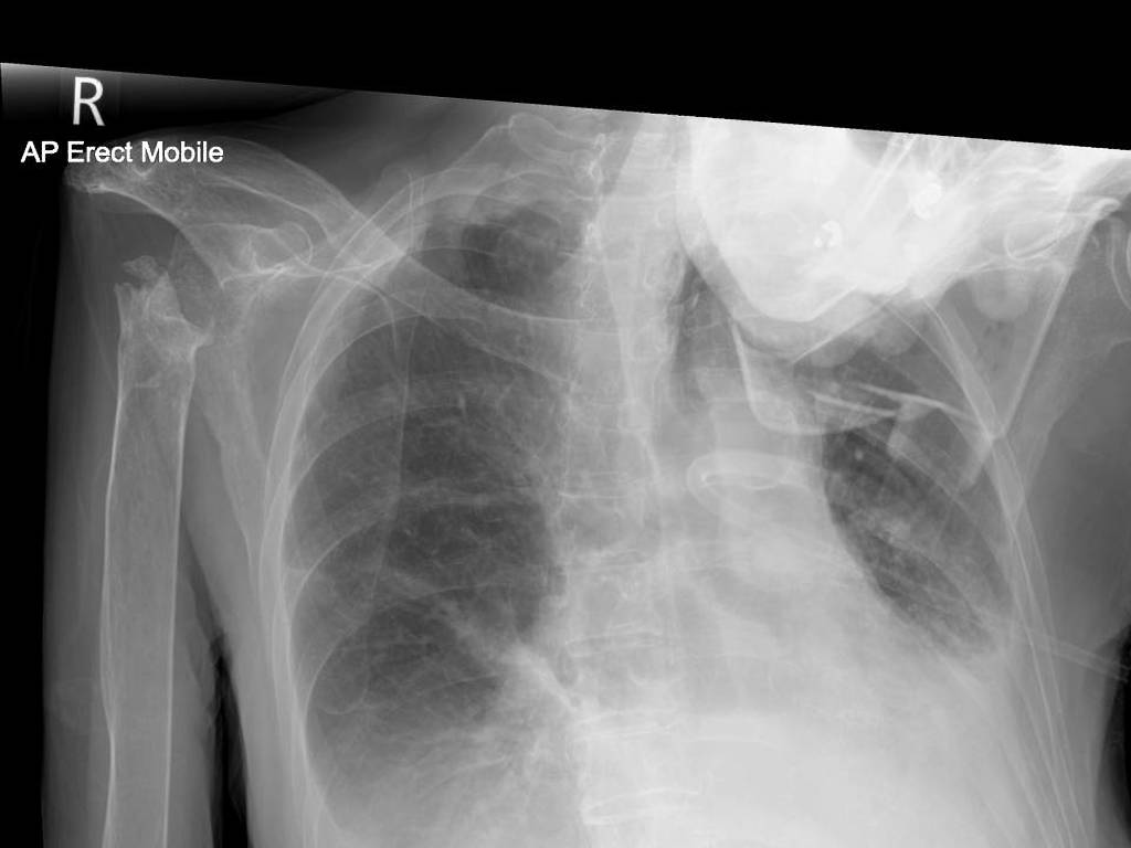 Oxygen Mask Radiology Case Radiopaedia Org