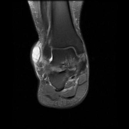 Superficial lateral malleolus bursa | Radiology Case | Radiopaedia.org