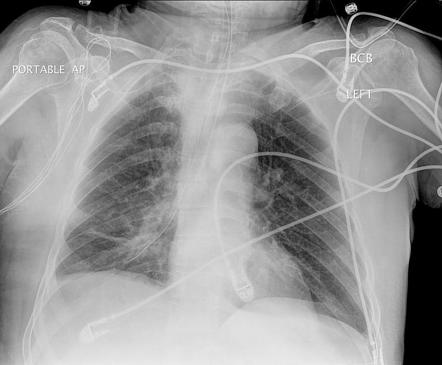 Malpositioned endotracheal and nasogastric tubes | Radiology Case ...