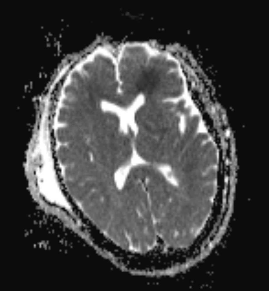 Carbon monoxide poisoning | Image | Radiopaedia.org