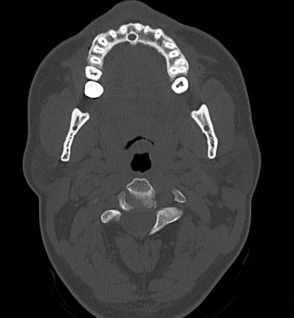 File:Petrous bone trauma - fracture, ossicular dislocation and ...