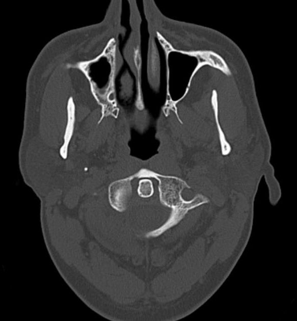 File:Petrous bone trauma - fracture, ossicular dislocation and ...