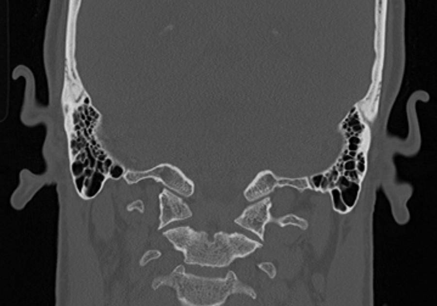 File:Petrous bone trauma - fracture, ossicular dislocation and ...