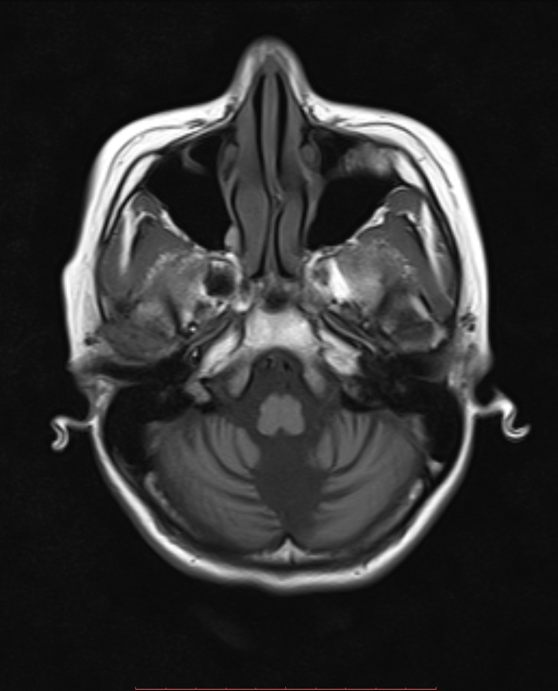 Global cerebellar hypoplasia | Image | Radiopaedia.org