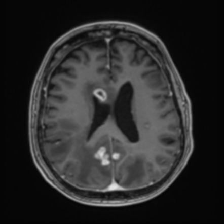 Primary Central Nervous System Posttransplant Lymphoproliferative ...