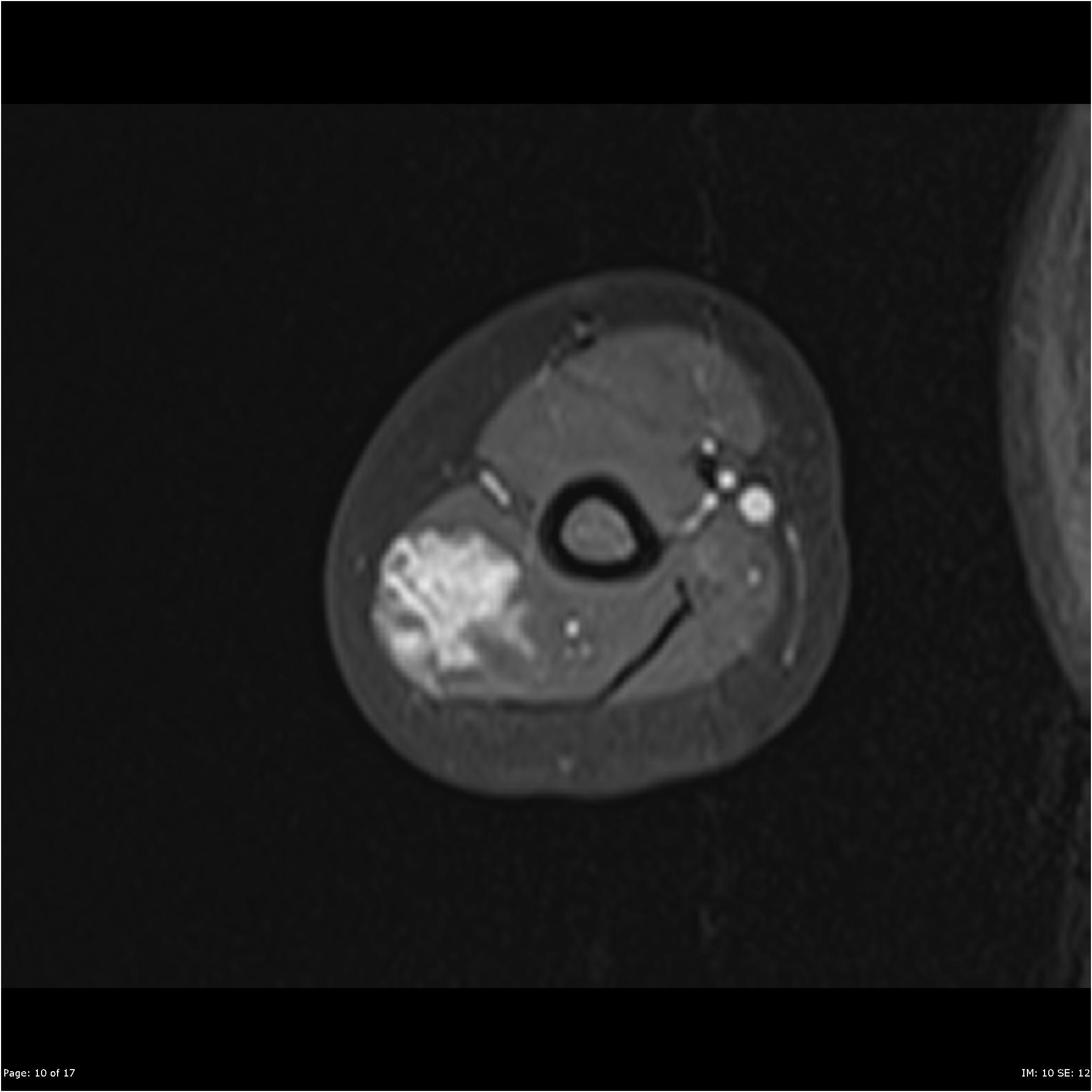 Intramuscular hemangioma Image