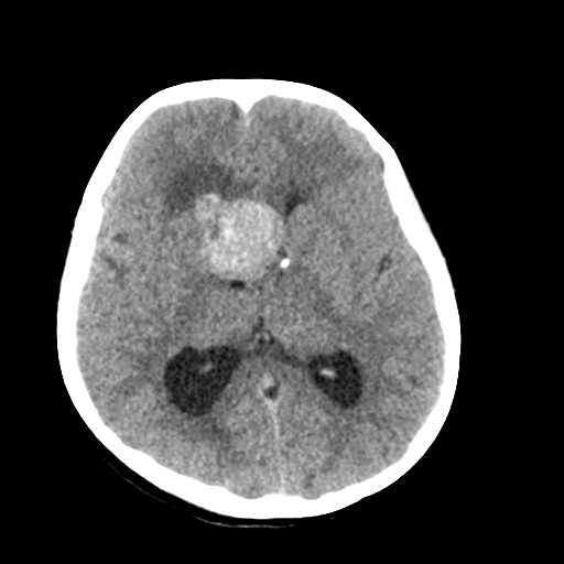 Tuberous Sclerosis With Subependymal Giant Cell Astrocytoma Image