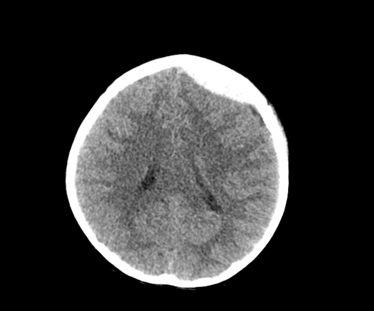 Acute epidural hematoma | Image | Radiopaedia.org