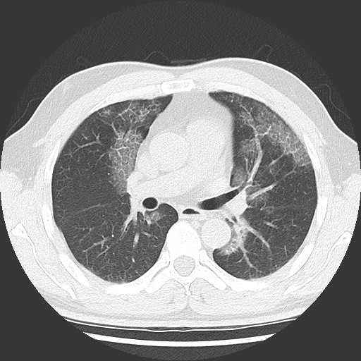 Pulmonary alveolar proteinosis | Image | Radiopaedia.org