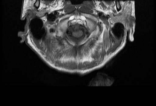 Atlantoaxial Subluxation Rheumatoid Arthritis Image