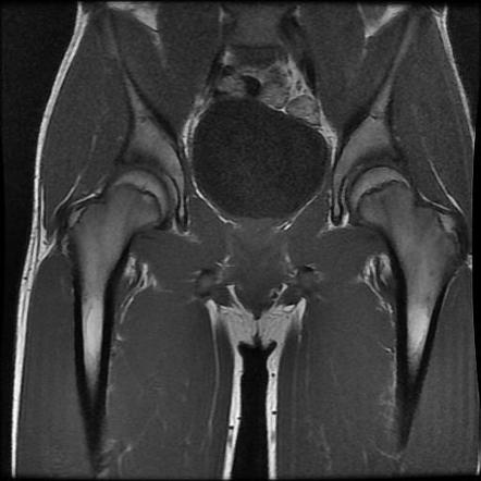 Proximal rectus femoris tendon tear | Image | Radiopaedia.org