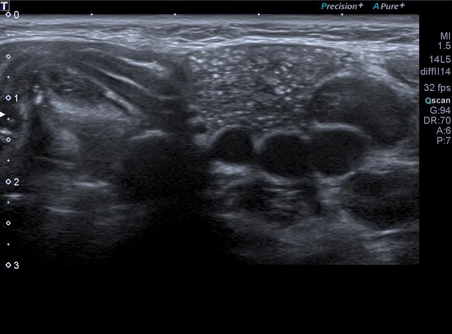 Cervical ectopic thymus | Image | Radiopaedia.org