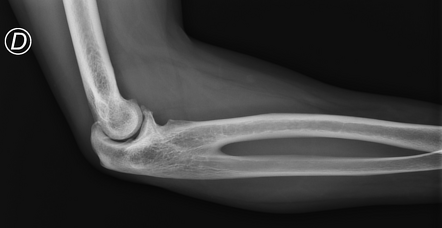 Bilateral proximal radioulnar synostosis | Radiology Case | Radiopaedia.org