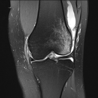 Deep lateral femoral notch sign | Image | Radiopaedia.org