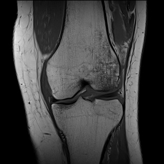 Deep lateral femoral notch sign | Image | Radiopaedia.org