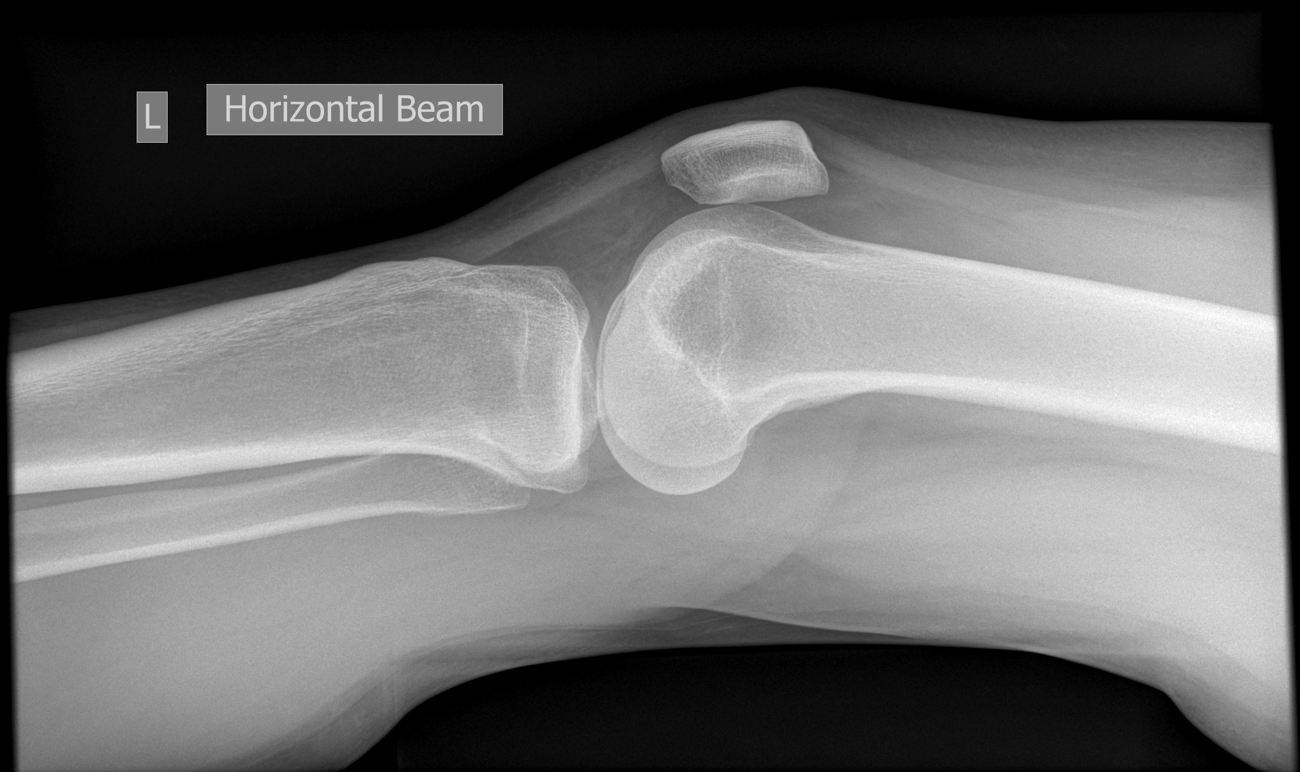 Deep lateral femoral notch sign | Image | Radiopaedia.org