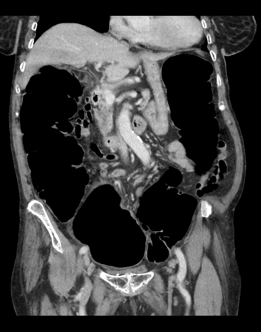 Ogilvie Syndrome Image