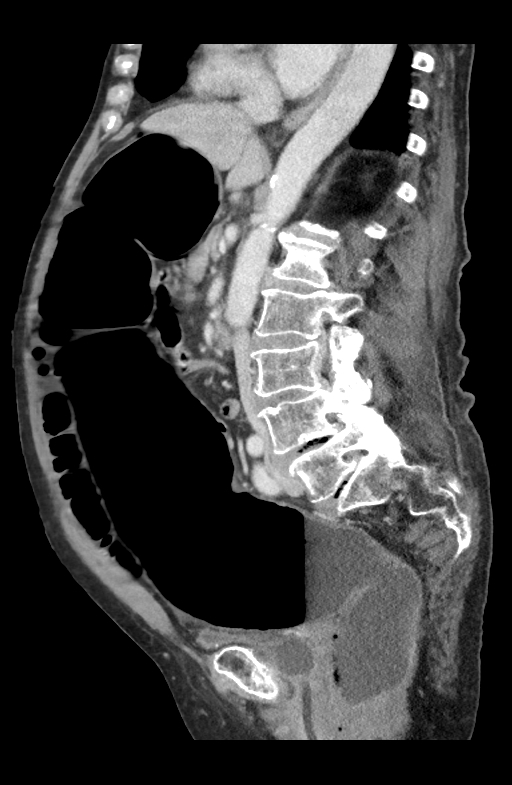 Ogilvie Syndrome Image