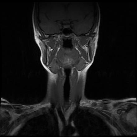 Paramedian Thyroglossal Duct Cyst | Image | Radiopaedia.org